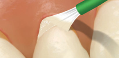 Vanish™ 5% Sodium Fluoride White Varnish
