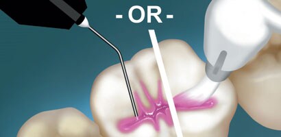 Clinpro™ Pit and Fissure Sealant

