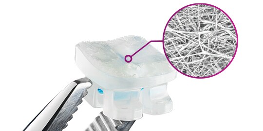 APC Flash-Free bracket adhesive detail
