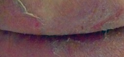 Moisture-Associated Skin Damage (MASD)
